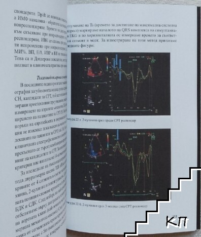 Сърдечна ресинхронизираща терапия (Допълнителна снимка 2)